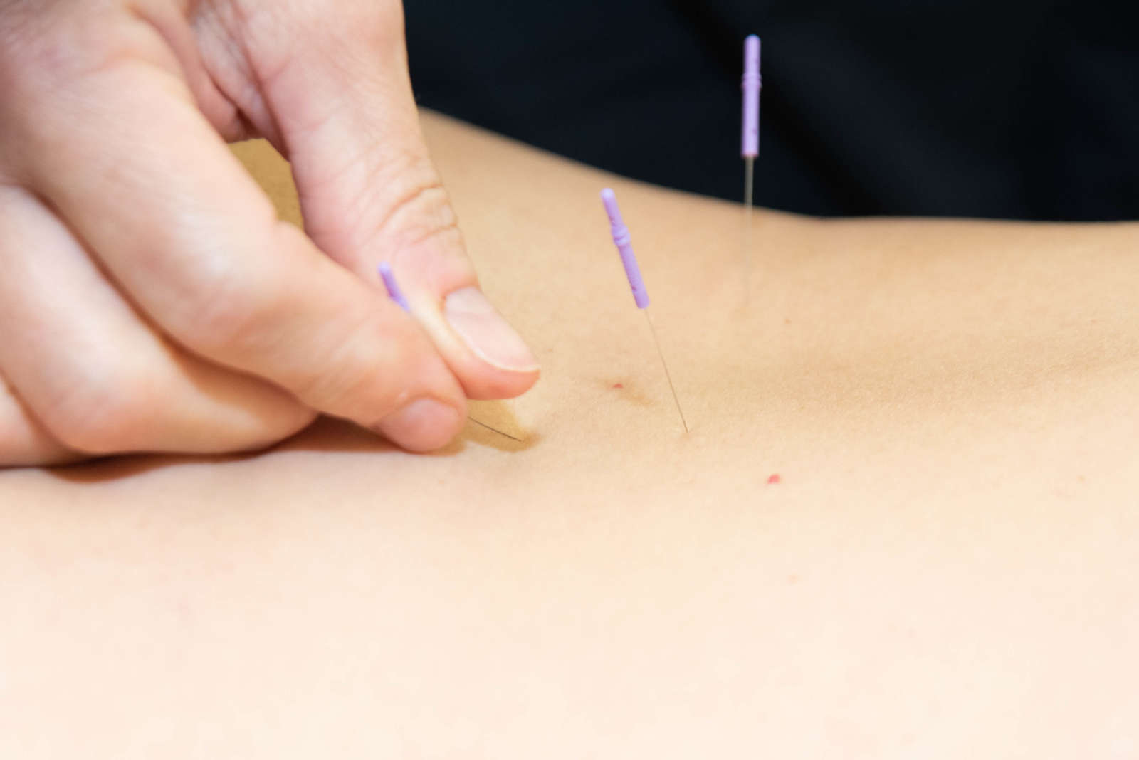 accupuncture-101